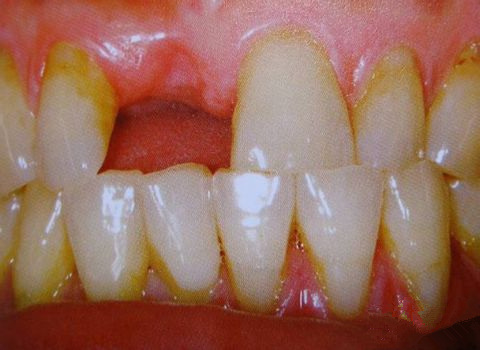 种植牙第一步：进行术前检查和术前处理